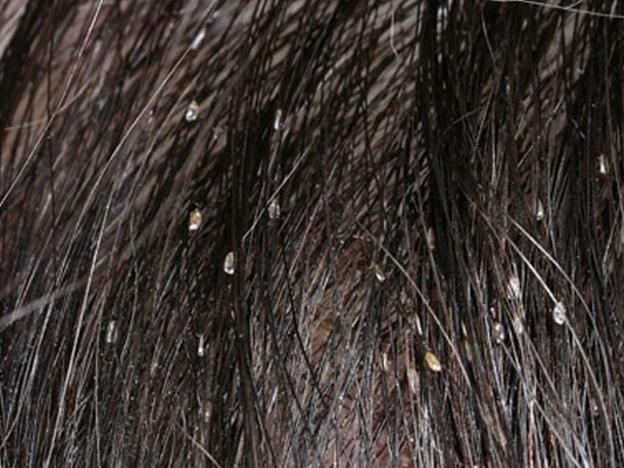 Mơ Thấy Trứng Chấy